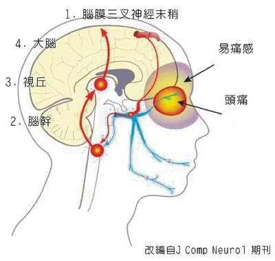 得了偏头痛怎么办？ 偏头痛怎么办