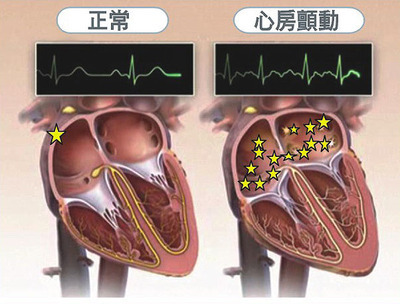 心房颤动 心房纤颤和心房颤动