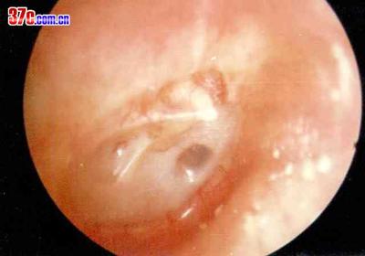 （摘录）关于小儿分泌性中耳炎的一点经验 急性分泌性中耳炎