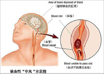 会移动的血栓 脑血栓的治疗方法