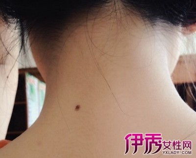 女生脖子左后面长痣，是什么意思？ 脖子后面有痣的女生