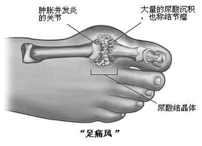 土家族神秘秘方：痛风六小时止痛消肿神方