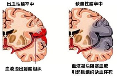 缺血性脑卒中的分类及治疗方案 缺血性脑卒中的治疗