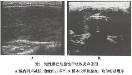 慢性淋巴细胞性甲状腺炎(二) 淋巴细胞甲状腺炎