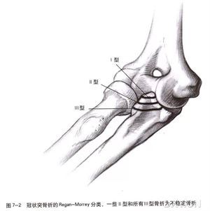 手把手教程：尺骨冠突骨折分型