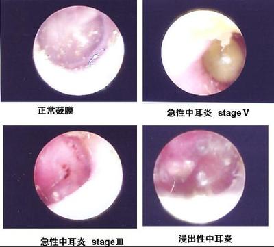 小儿耳膜穿孔怎么办 耳膜穿孔能治好吗