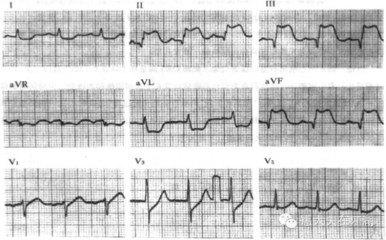关于心肌缺血 怎样检查急性心肌缺血
