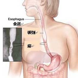 108.食管痛的各种治疗方法 食管癌治疗方法