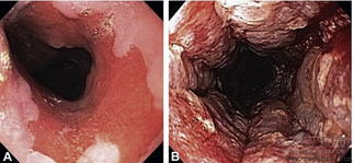 Barrett食管的内镜治疗 barrett食管炎治疗