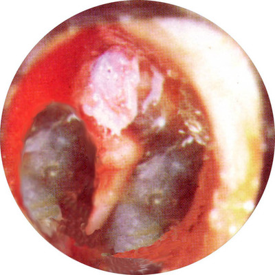 胆脂瘤型中耳炎手术治疗回忆+手术检查流程回忆 胆脂瘤中耳炎微创手术