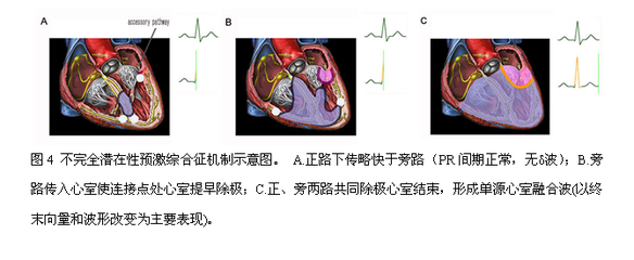 预激综合征：临床心电图的当前观点