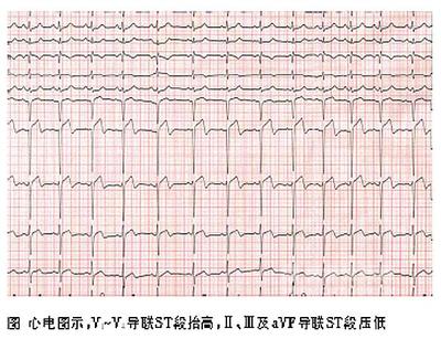 ST段与T波改变的判别及临床意义 t波高尖 st段抬高