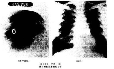 矽肺 矽肺的治疗