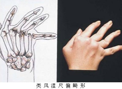 类风湿关节炎及16种病自愈（附检测报告） 下颌关节炎能自愈吗