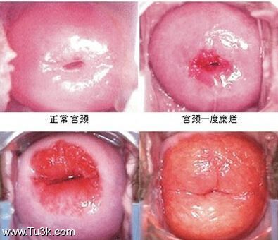 医学图片===宫颈照片 宫颈糜烂图片大全