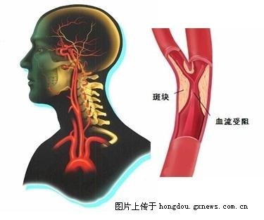 脑动脉硬化症 怎样防止血管硬化