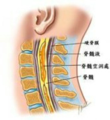 脊髓空洞症治愈率 脊髓空洞症能治好吗