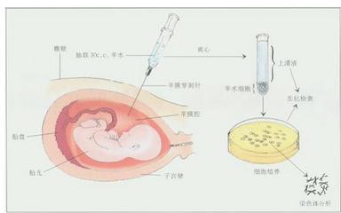 怀孕女硕士“绒毛穿刺”，性别鉴定畸形之罚 羊水穿刺后生出畸形儿