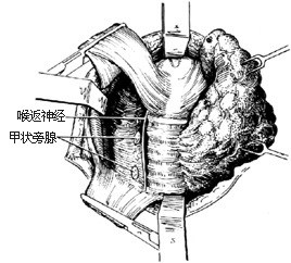 甲状腺腺瘤切除术 甲状腺结节哪里看好