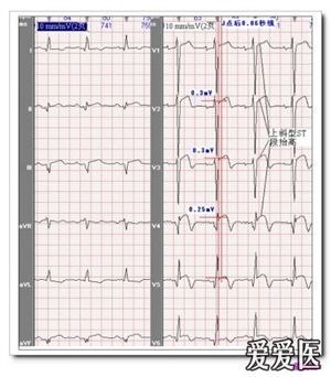 山羊老师课程常见心电图诊断知识讲座第二十五讲—— 急性心肌梗死 心肌梗死心电图