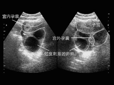 输卵管间质部妊娠 输卵管间质部和宫角