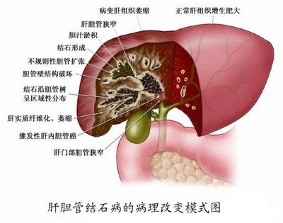 百元中药排走了肝内胆管结石 国外胆结石吃药