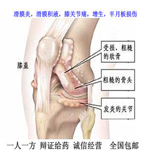 膝关节积液的特效秘验 膝关节积液