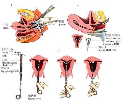 真人示范：女性上环全过程演示(组图)