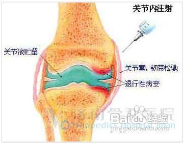 滑膜炎最佳治疗方法 ？ 滑膜炎的最佳治疗