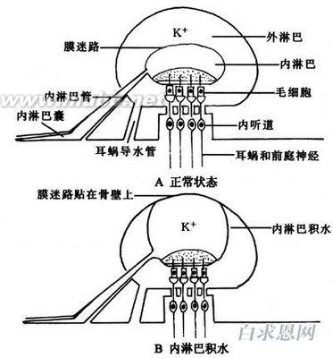 上海哪里治疗美尼尔症状有效？美尼尔氏综合症有哪些症状？江苏哪 美尼尔综合症的治疗