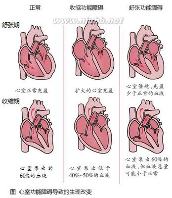 中医药辨治慢性心衰 慢性左心衰竭能治愈吗