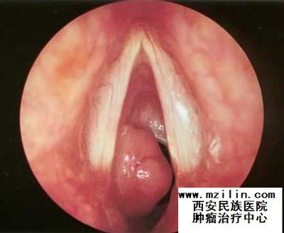 艾滋病潜伏期症状表现 艾滋病潜伏期症状