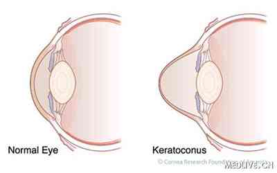 认识圆锥角膜 圆锥角膜多久会失明