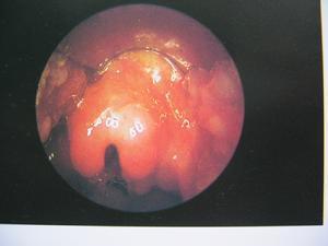 小儿急性喉炎（各家杂谈，来源丁香园） 小儿急性喉炎