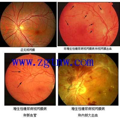 糖尿病眼病的早期症状 糖尿病眼病的特点