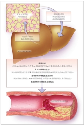 非酒精性脂肪性肝病证治 酒精脂肪肝怎么治