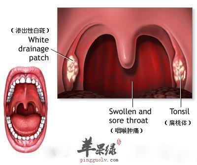 [半夏厚朴湯]...理氣開鬱，化痰散結，治慢性咽喉炎 化痰散结汤