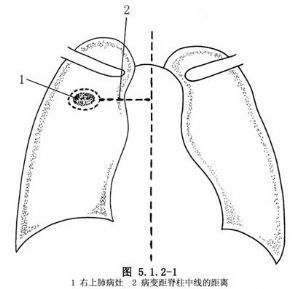 经皮肺穿刺及纵隔穿刺活检 肺癌穿刺活检必须做吗