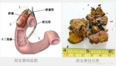 我成功排胆石和肝内胆管结石的经历 胆总管结石的治疗