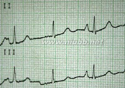 COPD：急性加重期的诊断和治疗（转）