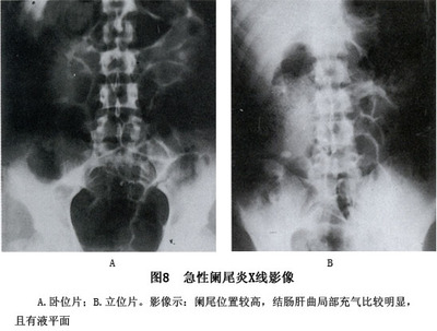 急性阑尾炎 阑尾炎专家咨询