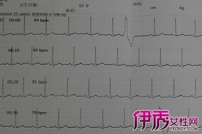 我的无器质性心脏病、有症状室性早搏的药物治疗总结 频发室性早搏的症状