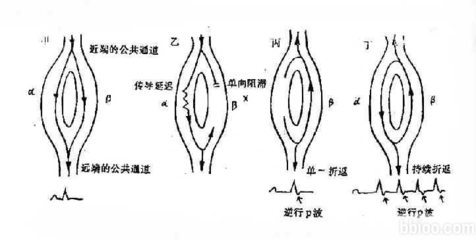 快速性心律失常 心律失常按其发生原理