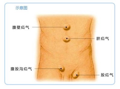 小儿疝气手术后注意事项 疝气需要动手术吗