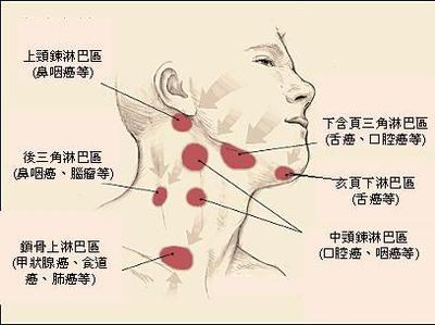 淋巴结肿大 脖子上有淋巴结正常吗