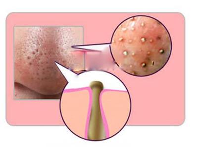黑头形成的原因 痘痘形成的原因讲解