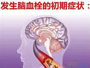 脑血栓前兆，当天6个暗号，为家人，看一眼！ 脑血栓前兆能治好吗