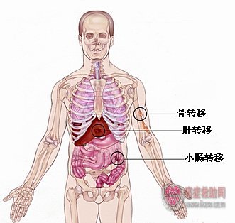 直肠癌晚期扩散还能活多久 直肠癌扩散症状