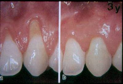 牙龈萎缩和牙周病 牙龈萎缩的治疗方法