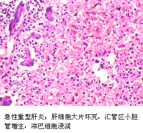 病理学园地：病毒性肝炎